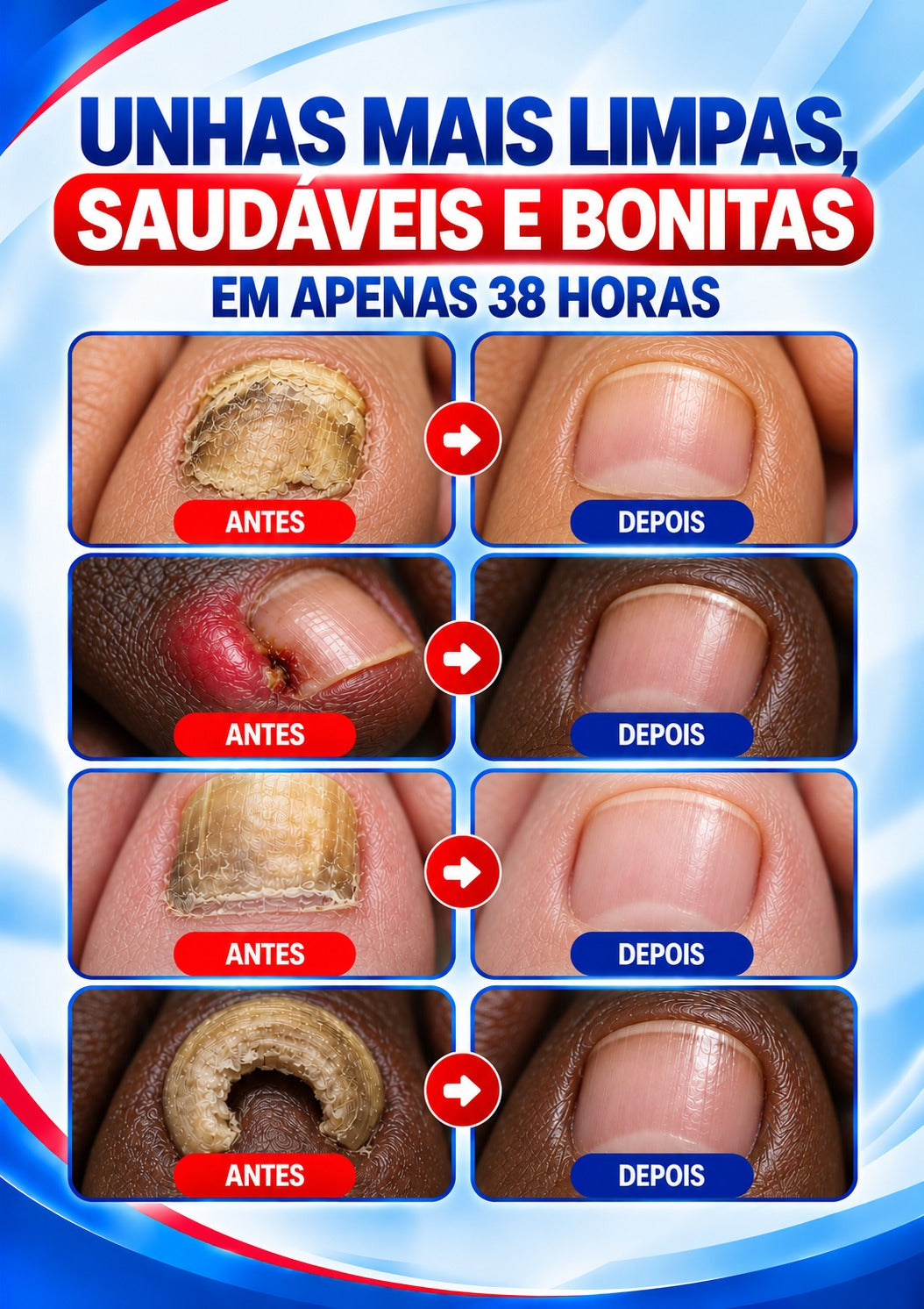 HidroNail™ - Pensos  Reparadores de Unhas.