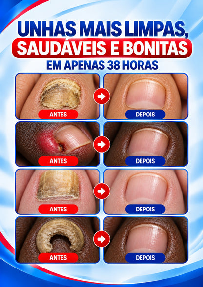 HidroNail™ - Pensos  Reparadores de Unhas.